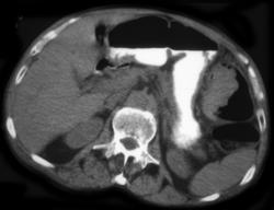 Colon Cancer With Colonic Obstruction - CTisus CT Scan