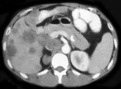 Liver Metastases & Cutaneous Cysts in Gardners Syndrome - CTisus CT Scan