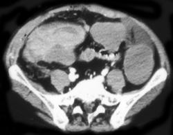 Mesenteric Hemorrhage S/P Colon Resection - CTisus CT Scan