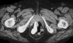 Prolapse of Small Bowel - CTisus CT Scan