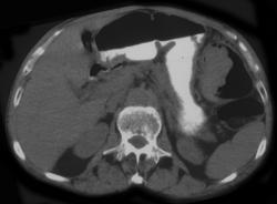 Obstructing Colon Cancer - CTisus CT Scan