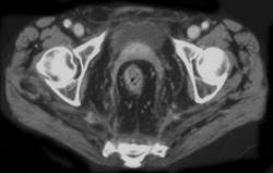 Crohn's Disease W/ Increased Fat Around Rectum - CTisus CT Scan