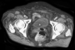 Diverticulitis W/colovaginal Fistulae - CTisus CT Scan