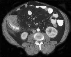 Appendicitis - CTisus CT Scan