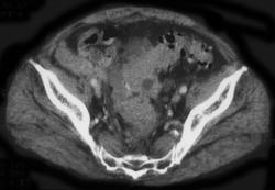 Diverticulitis - CTisus CT Scan