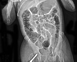 Colon Herniates Into Inguinal Ring - CTisus CT Scan