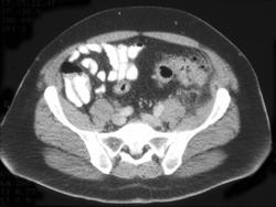 Diverticulitis - CTisus CT Scan