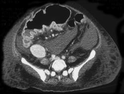 Pseudomembranous Colitis (PMC) - CTisus CT Scan