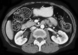 Ischemic Colitis Involving Splenic Flexure - CTisus CT Scan