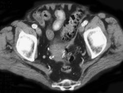 Diverticulitis - CTisus CT Scan