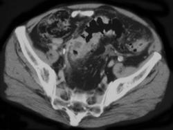 Diverticulitis - CTisus CT Scan