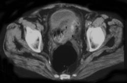 Diverticulitis - CTisus CT Scan