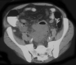 Diverticulitis W/abscess - CTisus CT Scan