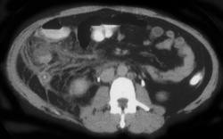 Appendicitis - CTisus CT Scan