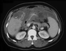 Pseudomyoma Peritonei - CTisus CT Scan