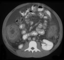 Pseudomembranous Colitis (PMC) - CTisus CT Scan