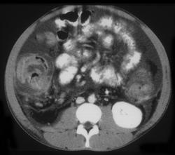 Pseudomembranous Colitis (PMC) - CTisus CT Scan