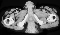 Perirectal Abscess and Recurrent Rectal Cancer - CTisus CT Scan