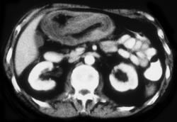 Colon Cancer W/intussusception - CTisus CT Scan