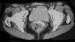 Colovaginal Fistulae - CTisus CT Scan