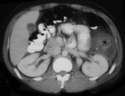 Diverticulitis - CTisus CT Scan