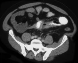 Diverticulitis - CTisus CT Scan