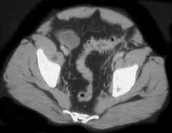 Diverticulitis - CTisus CT Scan