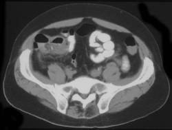 Appendicitis - CTisus CT Scan