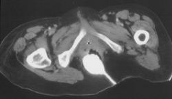 Recurrent Rectal Cancer Infiltrating Pelvis - CTisus CT Scan