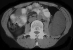 Lymphocele - CTisus CT Scan