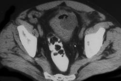 Colovesical Fistulae Due to Colon Cancer - CTisus CT Scan