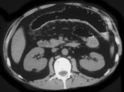 Ulcerative Colitis - CTisus CT Scan