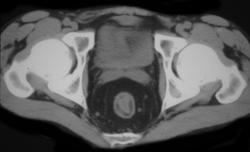 Halo and Ulcerative Colitis - CTisus CT Scan