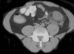 Diverticulitis - CTisus CT Scan