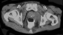 Rectal Cancer Infiltrates the Pelvis - CTisus CT Scan