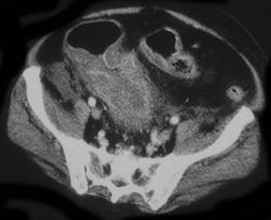 Pseudomembranous Colitis (PMC) - CTisus CT Scan