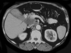 Portocaval Nodes-colon Cancer - CTisus CT Scan