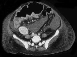 Pseudomembranous Colitis (PMC) - CTisus CT Scan