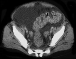 Pseudomembranous Colitis (PMC) - CTisus CT Scan