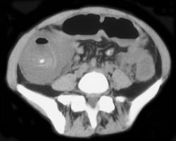 Typhlitis - CTisus CT Scan