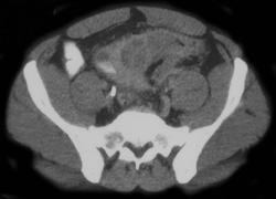 Diverticulitis W/fistulae to Bladder - CTisus CT Scan