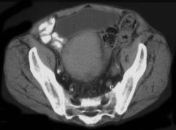 Hematoma S/P Colonoscopy - CTisus CT Scan