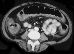 Pseudomembranous Colitis (PMC) - CTisus CT Scan