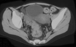 Infectious Colitis - CTisus CT Scan