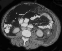 Colitis With Focal Perforation and Abscess - CTisus CT Scan