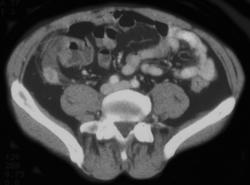 Appendicitis - CTisus CT Scan