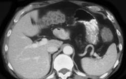 Colonic Urticaria - CTisus CT Scan