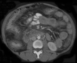 Pseudomembranous Colitis (PMC) - CTisus CT Scan