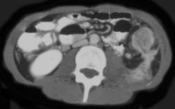 Ulcerative Colitis W/fistulae to Muscle - CTisus CT Scan