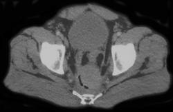 Hematoma Rectum S/P Bx - CTisus CT Scan